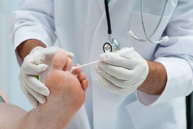 Ako imate simptome gljivica na noktima nogu, trebate se obratiti dermatologu ili mikologu. 