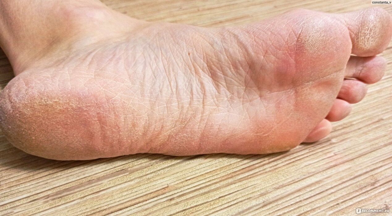 gljivice na ljudskom stopalu